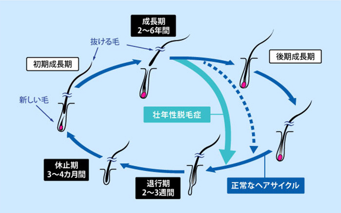 ヘアサイクルと壮年性脱毛症