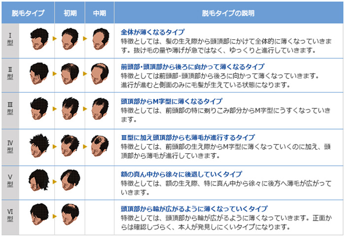 壮年性脱毛症のタイプ別の進行