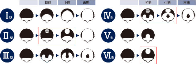 発毛剤はどれくらいの期間使うべきか