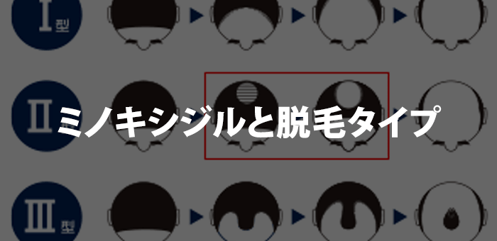 ミノキシジルと脱毛タイプ