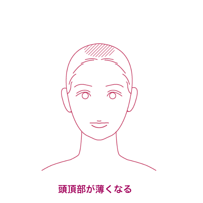 頭頂部が薄くなる