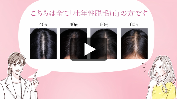 リアップリジェンヌ「あなたも壮年性脱毛症かも!?」